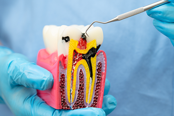 What Is Root Canal Treatment?